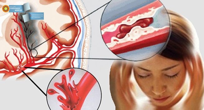 Trước khi quá muộn, hãy tự kiểm tra xem mạch máu có bị tắc hay không
